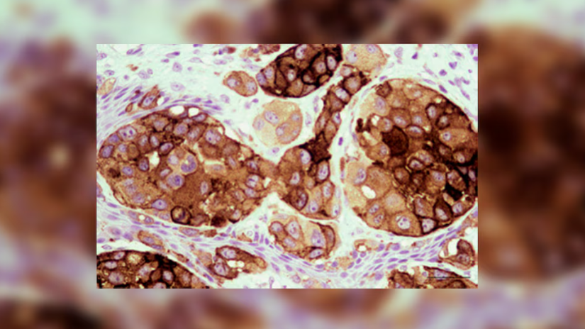 Vacuna argentina contra el melanoma: ya está disponible y abre una nueva etapa en terapias contra el cáncer de piel