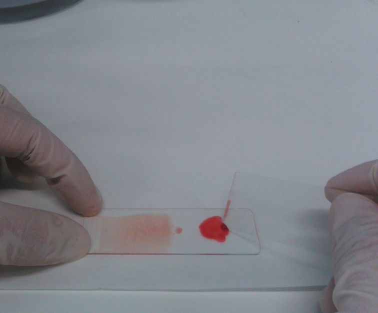 Hito médico: una gota de sangre enviada por correo permitiría detectar el Alzheimer desde casa